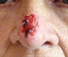 Nose Lesion