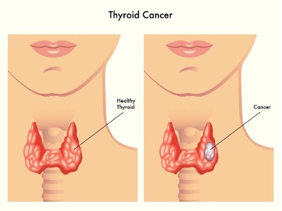 Thyroid Cancer Thyroid Cancer
